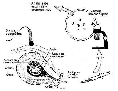 sindrome de down, Biopsia de las vellosidades coriónicas